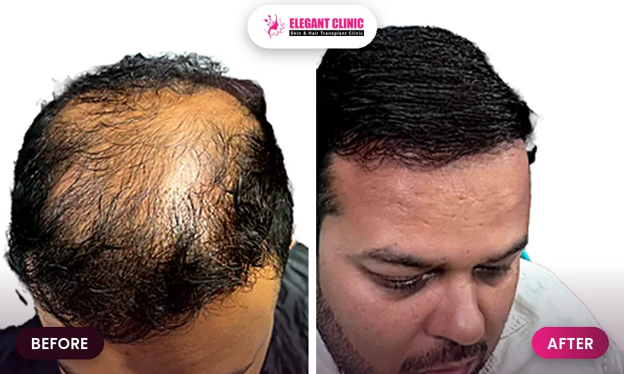 Hair transplant before and after result 1 - Elegant Clinic Patna