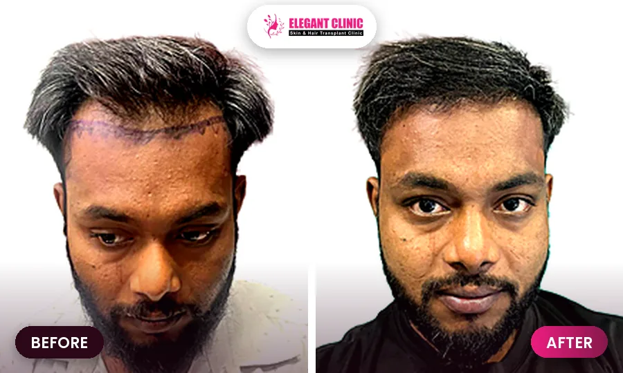 Hair transplant before and after result 2 - Elegant Clinic Patna