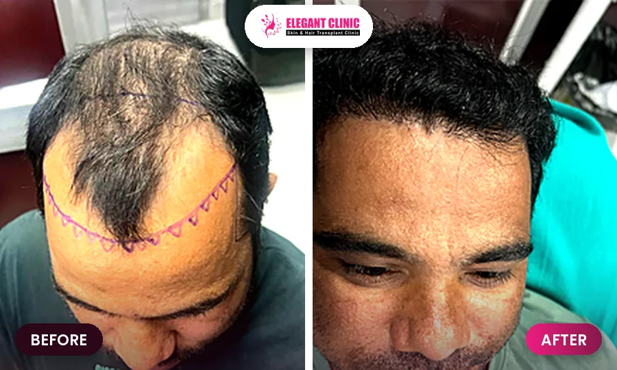 Hair transplant before and after result 3 - Elegant Clinic Patna