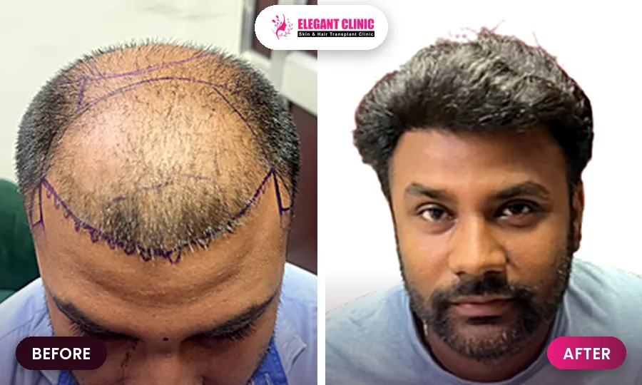 Hair transplant before and after result 4 - Elegant Clinic Patna