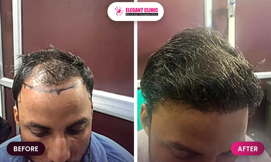 Hair transplant before and after result 5 - Elegant Clinic Patna