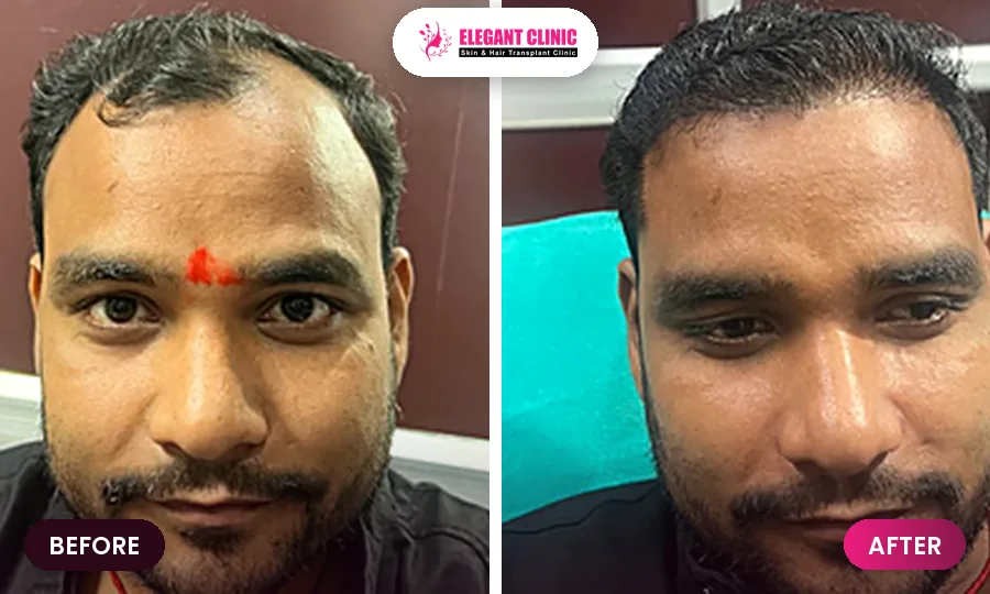 Hair transplant before and after result 6 - Elegant Clinic Patna