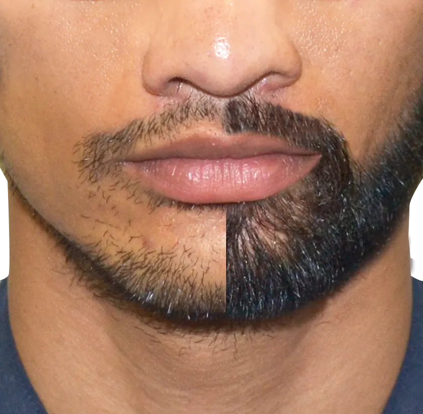 Beard transplant before and after - patchy beard filled
