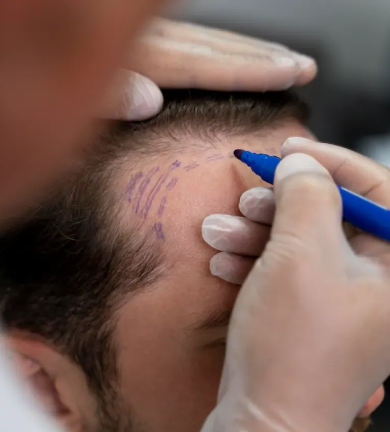 FUE hair transplant planning in Patna