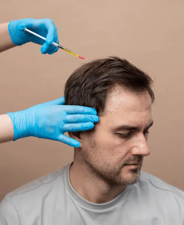 PRP injection being given in the scalp for hair loss treatment in Patna