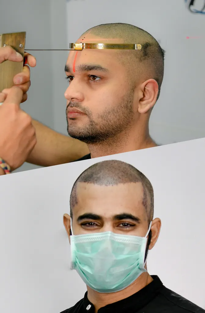 Patient before and during quick recovery hair transplant