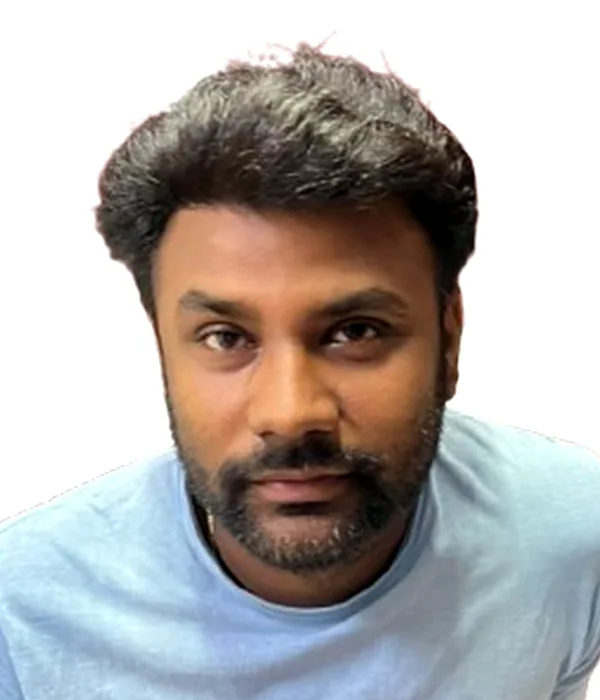 Hair transplant result
